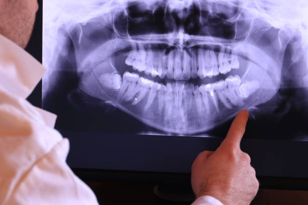 Best Emergency Wisdom Teeth Removal in Albany, MN