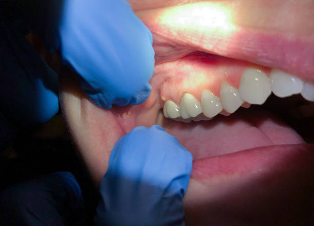 Best Urgent Care for Lost Fillings or Crowns in Albany, MN